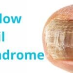 alt="Uña de dedo gordo del pie, de color cafe oscuro, se nota poco cuidado, la pies que la rodea tambien muestra señales de deshidratación"