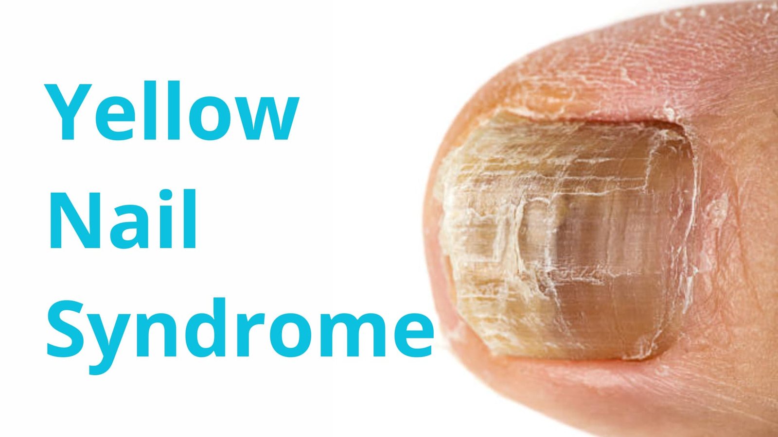 alt="Uña de dedo gordo del pie, de color cafe oscuro, se nota poco cuidado, la pies que la rodea tambien muestra señales de deshidratación"